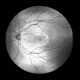 眼球結構斷層掃描（OCT）