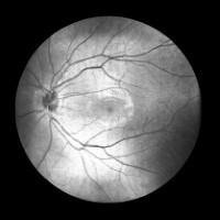 視網膜掃描攝影（SLO）